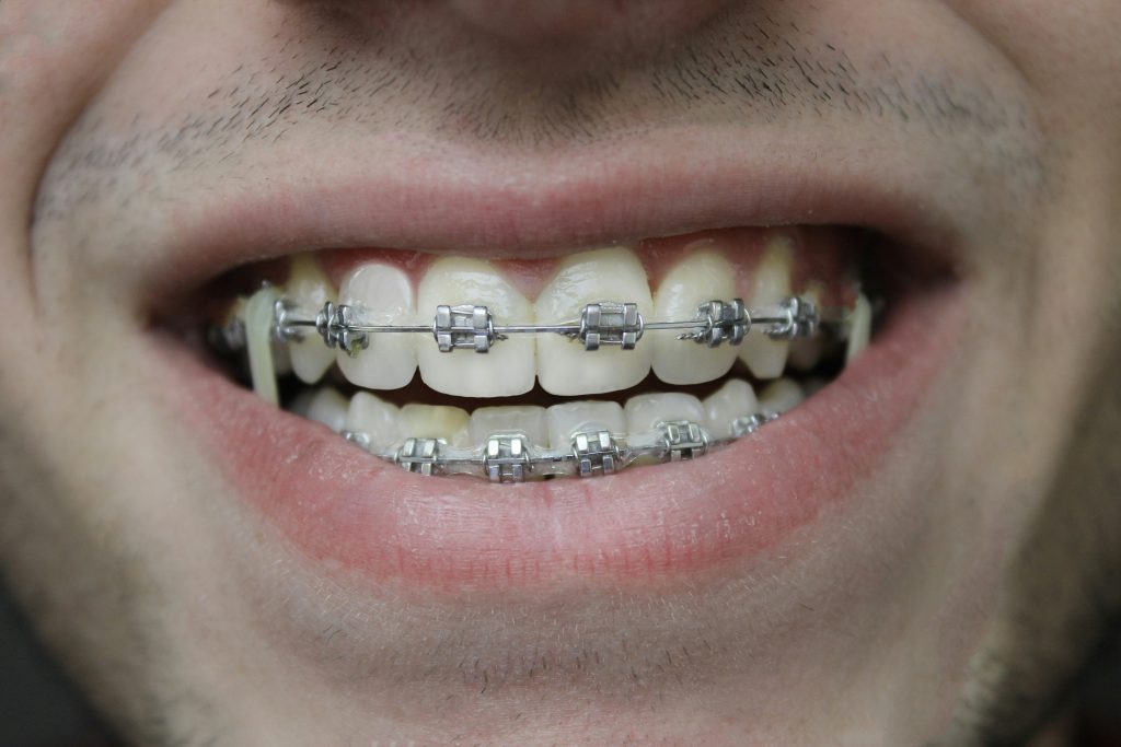 Brackets